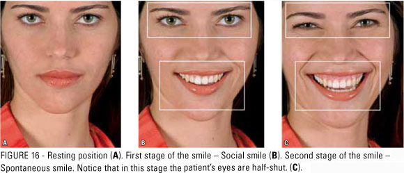 Smile progression